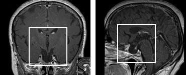 Hypophyse Makroadenom postperativ