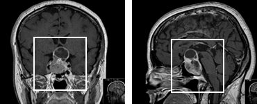 Hypophyse Makroadenom präoperativ