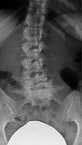 Ventro-dorso-ventrale Spondylodese LWK4-SWK1