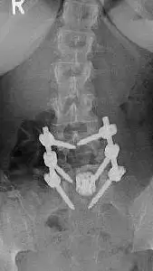 Spondylomptose in dorso-ventraler Technik