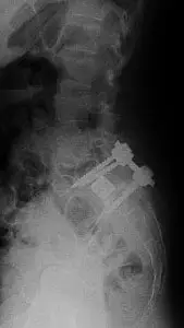 Spondylomptose in dorso-ventraler Technik